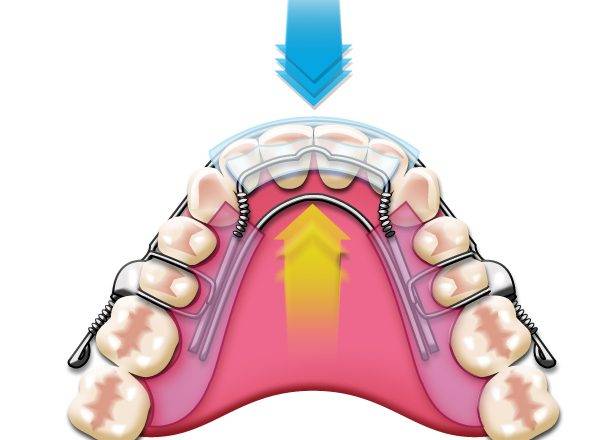 Prednosti nevidnega zobnega aparata