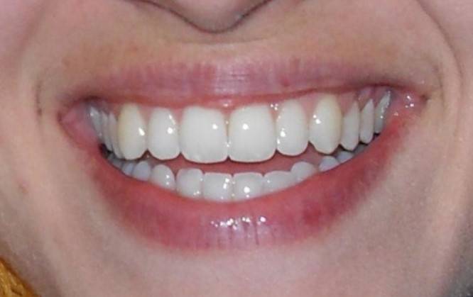 Zobne luske iz porcelana odražajo lastnosti naravnih zob